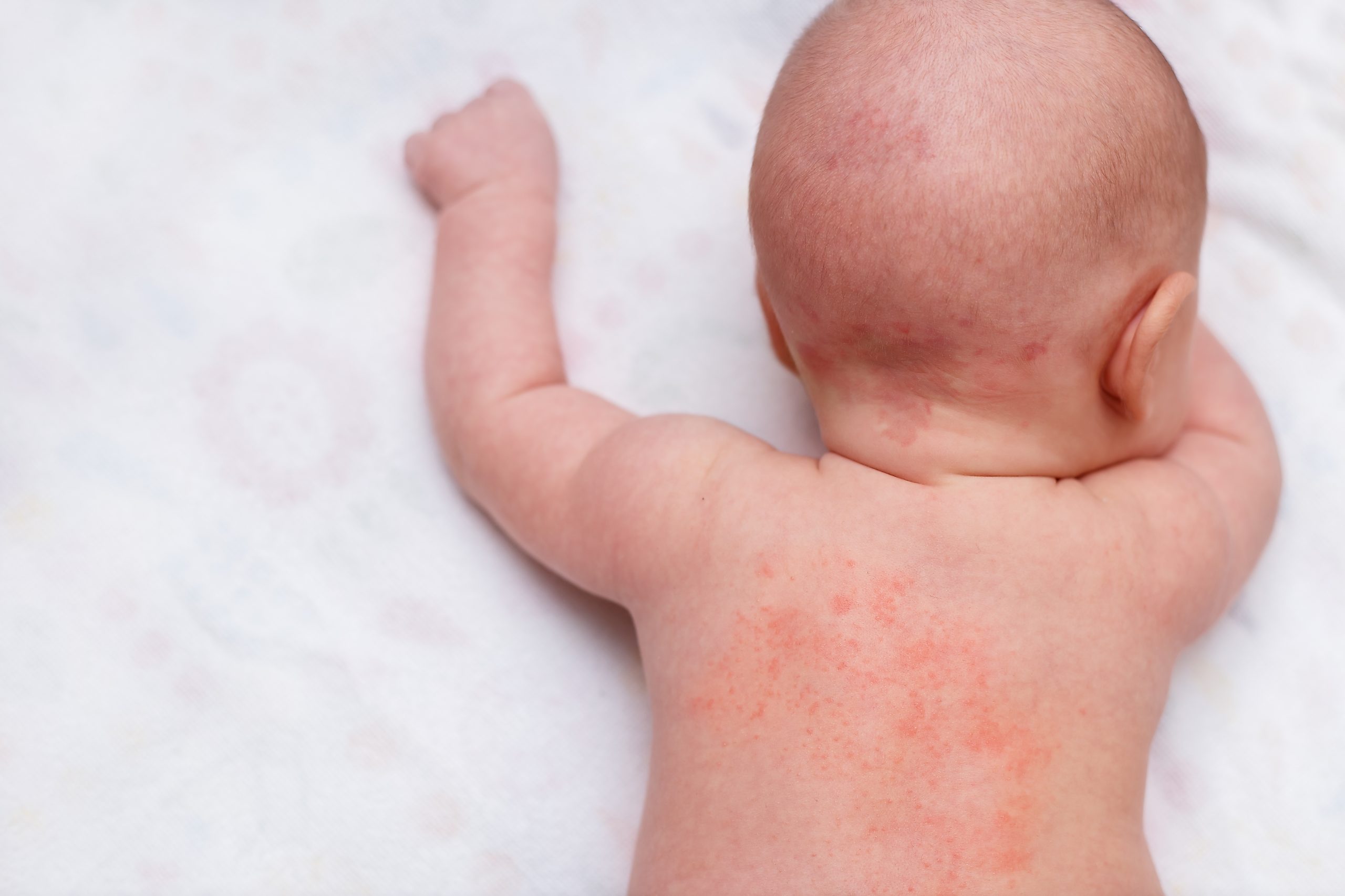 Miliaria,,Prickly,Heat,On,Baby's,Back.