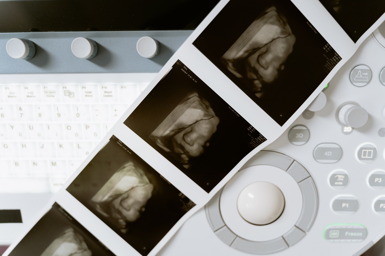 Određivanje pola bebe u trudnoći